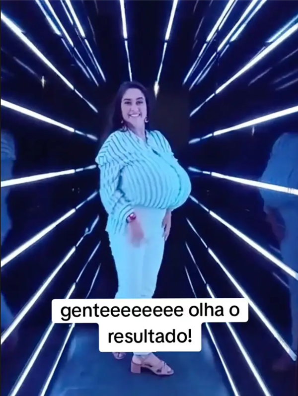 巴西女子患“巨乳症”失控！短短几月长O杯 出行得坐轮椅