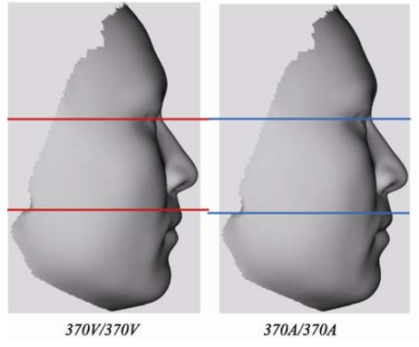 父母都是高颜值 孩子却很丑 丑基因真的更强大吗