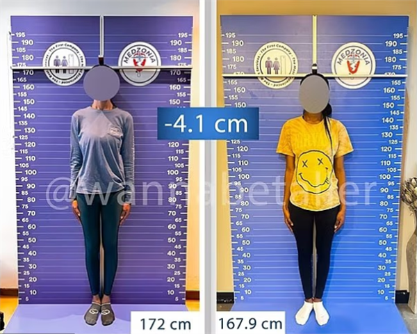 太疯狂！嫌个子太高不好找对象 女子手术切骨变矮