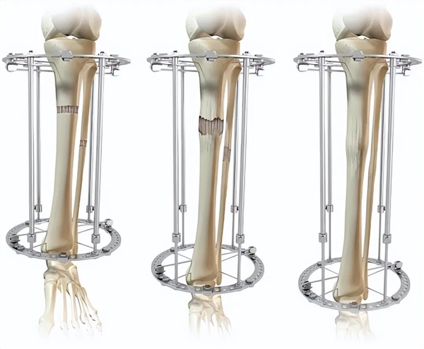 太疯狂！嫌个子太高不好找对象 女子手术切骨变矮