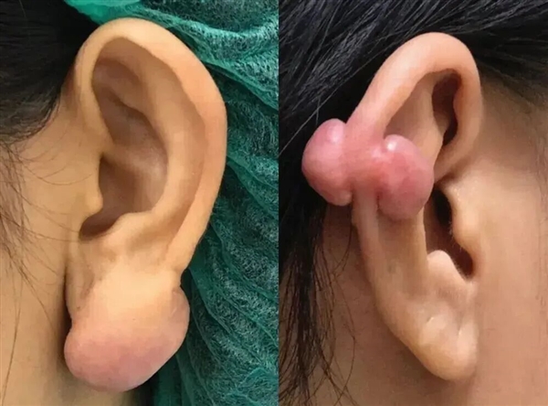 为什么没有人告诉我 打耳洞后会长这种肉疙瘩啊