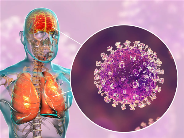 印度这致死率75%的尼帕病毒 真的会成为下一个新冠吗