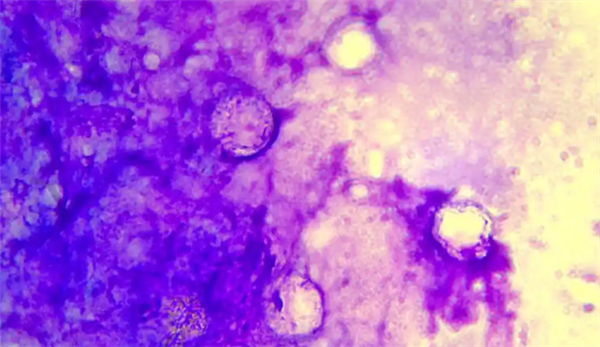 广西一女子左眼剧痛眼球差点不保！医生：感染了食脑虫