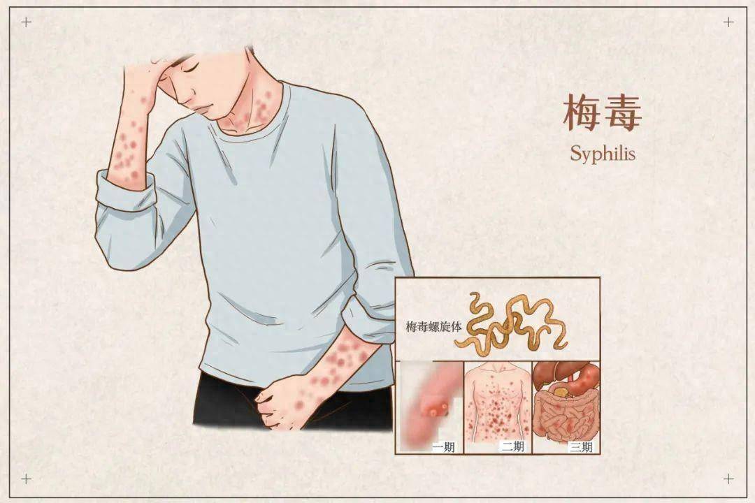 划重点！除了性接触，这些行为也可能传播梅毒