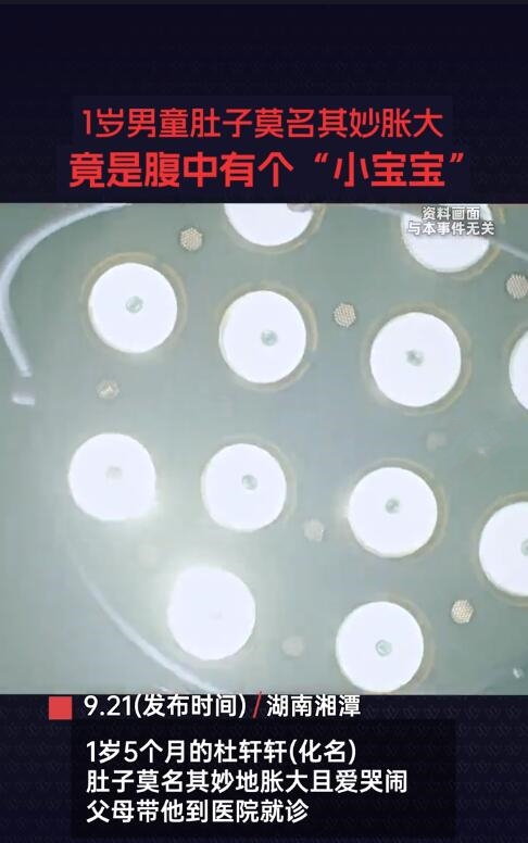 1岁男童腹中竟有个小宝宝:医学罕见