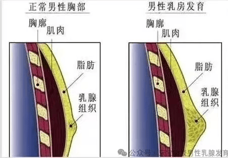 男性乳腺发育往往伴随着乳晕增大 
